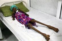 ਪਿੰਜਰ ਬਣਦੇ ਜਾ ਰਹੇ ਨੇ ਇੱਥੋਂ ਦੇ ਲੋਕ..ਡਾਕਟਰਾਂ ਦੇ ਬੱਸੋ ਬਾਹਰ