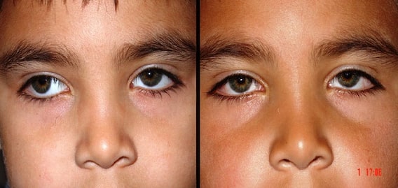 Eyes Problem: ਅੱਖਾਂ 'ਚ ਟੀਰ ਕਿਉਂ ਪੈਂਦਾ ਤੇ ਕੀ ਹੈ ਇਸਦਾ ਹੱਲ ਜਾਣੋ