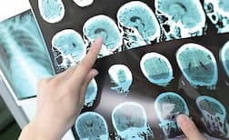 ਸਟ੍ਰੋਕ ਦੇ ਨੁਕਸਾਨ ਤੋਂ ਦਿਮਾਗ਼ ਨੂੰ ਬਚਾਏਗੀ ਖਾਸ ਦਵਾਈ