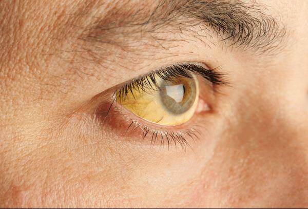 ਮੂਲੀ ਨਾਲ ਜਾਨਡਿਸ ਯਾਨੀ ਪੀਲੀਆ ਦੇ ਮਰੀਜਾਂ ਦੇ ਲਈ ਬਹੁਤ ਫਾਇਦਮੰਦ ਹੈ। ਜਿੰਨਾਂ ਲੋਕਾਂ ਨੂੰ ਪੀਲੀਆ ਹੋ ਚੁੱਕਿਆ ਹੈ ਜਾਂ ਜਿਹੜੇ ਇਸਤੋਂ ਰਿਕਵਰ ਕਰ ਰਹੇ ਹਨ ਉਨ੍ਹਾਂ ਮੂਲੀ ਦੇ ਨਮਕ ਦੇ ਨਾਲ ਜ਼ਰੂਰੀ ਖਾਣਾ ਚਾਹੀਦਾ ਹੈ ਇਸ ਨਾਲ ਪੀਲੀਆ ਜਲਦੀ ਠੀਕ ਹੋ ਜਾਂਦਾ ਹੈ।