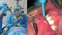 ਡਾਕਟਰਾਂ ਦਾ ਕਮਾਲ: ਪੱਟ ਦੇ ਮਾਸ ਤੋਂ ਬਣਾਈ ਵਿਅਕਤੀ ਦੀ ਜੀਭ