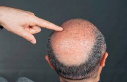 ਗੰਜੇਪਣ ਤੇ ਵਾਲ ਝੜਨ ਦਾ ਲੱਭਿਆ ਰਾਜ਼!