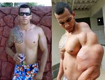 ਬਾਡੀ ਬਿਲਡਰ ਬਣਨ ਲਈ ਲਾਏ ਤੇਲ ਤੇ ਸ਼ਰਾਬ ਦੇ ਟੀਕੇ, ਫਿਰ ਜੋ ਵਾਪਰਿਆ ਜਾਣ ਕੇ ਹੋ ਜਾਓਗੇ ਹੈਰਾਨ!