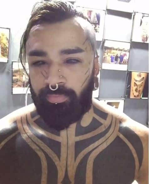 ਇਸ ਸਰਜ਼ਰੀ ਦੇ ਬਾਅਦ ਸ਼ੁਰੂਆਤ 'ਚ ਧੁੱਪ ਦੇ ਚਸ਼ਮੇ ਬਿਨ੍ਹਾਂ ਬਾਹਰ ਨਿਕਲਨਾ ਸੰਭਵ ਨਹੀਂ ਹੁੰਦਾ। ਇਸ ਸਰਜਰੀ ਦੇ ਬਾਅਦ ਅੱਖਾਂ ਤੋਂ ਪਾਣੀ ਆਉਣਾ,ਜਲਣ ਹੋਣਾ ਆਮ ਗੱਲ ਹੈ। 
