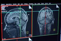 ਬ੍ਰਿਟਿਸ਼ ਵਿਗਿਆਨੀਆਂ ਵੱਲੋਂ ਦਿਮਾਗ਼ ਬਾਰੇ ਵੱਡੀ ਖੋਜ, ਇਲਾਜ ਦਾ ਖੁੱਲ੍ਹਿਆ ਨਵਾਂ ਰਾਹ