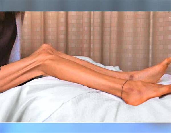  ਮੈਂ ਇਸ ਲਈ ਨਿਊਟ੍ਰੀਸ਼ੀਅਨ ਮਾਹਰਾਂ ਤੋਂ ਟਿਪਸ ਲਏ, ਚੰਗਾ ਖਾਣਾ ਖਾਣ ਦੀ ਕੋਸ਼ਿਸ਼ ਕੀਤੀ ਪਰ ਕੁੱਝ ਕੰਮ ਨਹੀਂ ਆਇਆ। ਸਟੈਫਨੀ ਨੇ ਹਾਲ ਹੀ ਵਿਚ ਇੱਕ ਟੀ. ਵੀ. ਵਿਚ ਸ਼ੋਅ ਵਿਚ ਭਾਗ ਲਿਆ, ਜਿੱਥੇ ਡਾਕਟਰਾਂ ਨੇ ਉਸ ਦਾ ਉਦਾਹਰਨ ਦੇ ਕੇ ਡਾਈਟਿੰਗ ਨਾਲ ਹੋਣ ਵਾਲੇ ਖ਼ਤਰਿਆਂ ਦੇ ਬਾਰੇ ਵਿਚ ਵੀ ਲੋਕਾਂ ਨੂੰ ਸੁਚੇਤ ਕੀਤਾ।