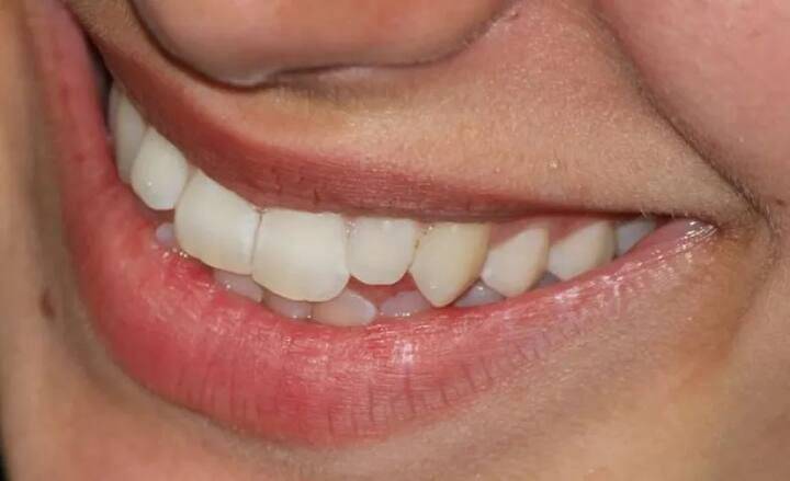 ਜੇ ਮਸੂੜਿਆਂ ਵਿੱਚ ਸੋਜ਼ਿਸ਼ ਹੋਏ ਤੇ ਖ਼ੂਨ ਵਗਦਾ ਹੋਏ ਤਾਂ ਡਾਕਟਰ ਦੀ ਸਲਾਹ ਲਉ। ਦੰਦਾਂ ਤੇ ਮਸੂੜਿਆਂ ਦੇ ਦਰਦ ਨੂੰ ਅਣਦੇਖਾ ਨਾ ਕਰੋ।