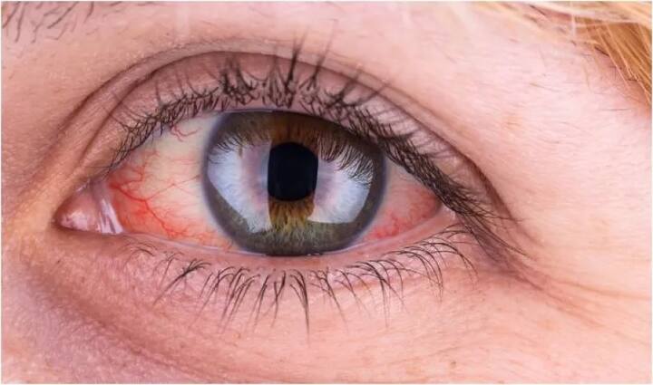 ਅੱਖਾਂ 'ਚ ਰੁੱਖਾਪਣ- ਤਕਨਾਲੋਜੀ ਦੇ ਇਸ ਦੌਰ 'ਚ ਅੱਜ ਦੇ ਨੌਜਵਾਨ ਕੰਪਿਊਟਰ ਤੇ ਸਮਾਰਟਫੋਨ ਤੋਂ ਬਹੁਤਾ ਦੂਰ ਨਹੀਂ ਹੋ ਸਕਦੇ। ਇਸ ਦੀ ਜ਼ਿਆਦਾ ਵਰਤੋਂ ਨਾਲ ਵੀ ਅੱਖਾਂ 'ਚ ਰੁੱਖਾਪਣ ਆ ਜਾਂਦਾ ਹੈ। ਕਿਸੇ ਦਵਾਈ ਦੇ ਰਿਐਕਸ਼ਨ ਨਾਲ ਵੀ ਅੱਖਾਂ 'ਚ ਰੁੱਖਾਪਣ ਆ ਸਕਦਾ ਹੈ। ਆਮ ਤੌਰ 'ਤੇ ਵਿਟਾਮਿਨ ਏ ਦੀ ਕਮੀ ਨਾਲ ਅਜਿਹਾ ਹੁੰਦਾ ਹੈ।