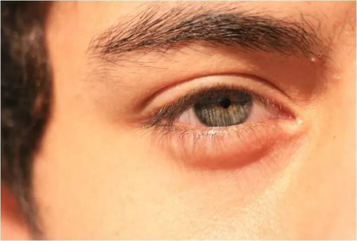 ਅੱਖਾਂ ਦੁਆਲੇ ਸੋਜ- ਕਦੇ-ਕਦੇ ਅੱਖਾਂ ਦੇ ਆਸ-ਪਾਸ ਸੋਜ ਹੋ ਜਾਂਦੀ ਹੈ। ਅਜਿਹਾ ਉਸ ਵੇਲੇ ਹੁੰਦਾ ਹੈ ਜਦੋਂ ਤੁਸੀਂ ਸੋਡੀਅਮ ਦਾ ਵਧੇਰੇ ਸੇਵਨ ਕਰਦੇ ਹੋ। ਇਸ ਤੋਂ ਬਚਣ ਲਈ ਤੁਸੀਂ ਕੇਲਾ ਖਾ ਸਕਦੇ ਹੋ। ਪਾਣੀ ਜ਼ਿਆਦਾ ਪੀਣ ਨਾਲ ਵੀ ਅੱਖਾਂ ਦੇ ਆਸ-ਪਾਸ ਦੀ ਸੋਜ ਘਟਦੀ ਹੈ।