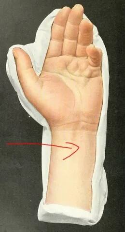 ਲਾਂਗ ਪਾਮਰ ਮਸਲਜ਼- ਇਸ ਬਾਰੇ ਜਿਆਦਾ ਜਾਣਕਾਰੀ ਮੌਜੂਦ ਨਹੀਂ। ਅਜਿਹਾ ਮੰਨਿਆ ਜਾਂਦਾ ਹੈ ਕਿ ਕੁਝ ਲੋਕਾਂ ਵਿੱਚ ਇਹ ਮਸਲਜ਼ ਨਹੀਂ ਹੁੰਦੀਆਂ