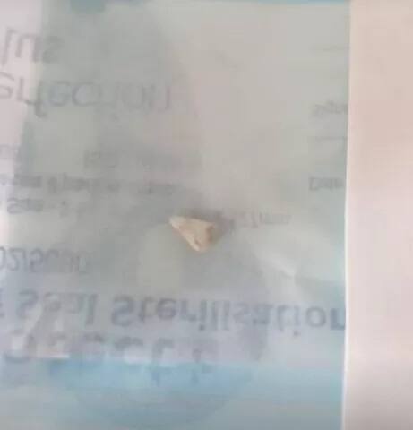 ਅਜਿਹੇ ਹਾਲਤ ਵਿੱਚ ਡਾਕਟਰ ਨੇ ਕਾਫੀ ਵਿਚਾਰ-ਵਟਾਂਦਰਾ ਕੀਤਾ ਕਿ ਛੋਟੇ ਬੱਚੇ ਦਾ ਇਲਾਜ ਕਿਵੇਂ ਕੀਤਾ ਜਾਵੇ। ਇਸ ਤੋਂ ਬਾਅਦ ਤਾਰਾ ਆਪਣੇ ਬੱਚੇ ਨੂੰ ਕਿਸੇ ਹੋਰ ਹਸਪਤਾਲ ਲੈਕੇ ਗਈ। ਉੱਥੇ ਜਾ ਕੇ ਡਾਕਟਰਾਂ ਨੇ ਉਸ ਦਾ ਦੰਦ ਹਟਾ ਦਿੱਤਾ। ਹੁਣ ਬੱਚਾ ਠੀਕ ਹੈ ਤੇ ਉਸ ਦਾ ਦੰਦ ਵੀ ਕੋਈ ਤਕਲੀਫ਼ ਨਹੀਂ ਕਰਦਾ।