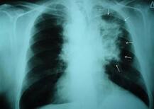 ਪ੍ਰਦੂਸ਼ਣ ਨਾਲ ਵਧ ਰਿਹਾ ਫੇਫੜਿਆਂ ਦਾ ਕੈਂਸਰ, ਇੱਕ ਛੋਟੀ ਜਿਹੀ ਆਦਤ ਬਚਾ ਸਕਦੀ ਜਾਨ