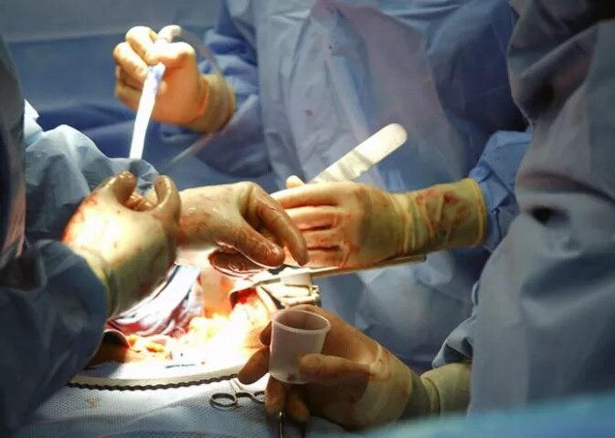 Kidney Transplant After three try man ends up with five kidneys in body Kidney Transplant: বিরল অস্ত্রোপচার, দেহে ৫টি কিডনি বসল এক ব্যক্তির