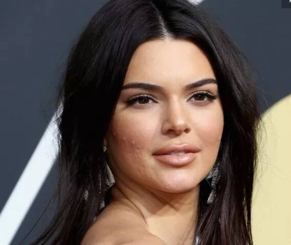 ਮਾਡਲ ਤੇ ਅਦਾਕਾਰਾ ਕੇਂਡਲ ਜੇਨਰ ਨੇ ਦੱਸਿਆ ਕਿ ਜਦੋਂ ਉਹ ਜਵਾਨ ਸੀ ਤਾਂ ਉਸ ਨੂੰ ਕਿੱਲਾਂ ਦੀ ਕਾਫੀ ਦਿੱਕਤ ਹੋ ਗਈ ਸੀ। ਉਹ ਹਰ ਥਾਂ ਆਪਣਾ ਚਿਹਰਾ ਲੁਕਾ ਕੇ ਘੁੰਮਦੀ ਸੀ।