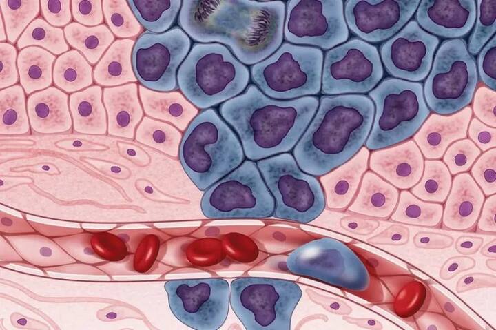 ਖੋਜ ਵਿੱਚ ਪਤਾ ਲੱਗਾ ਕਿ ਆਮ ਤੌਰ ’ਤੇ ਫੇਫੜੇ, ਢਿੱਡ, ਅੰਤੜੀਆਂ ਤੇ ਗ੍ਰਾਸਨਲੀ ਵਿੱਚ ਹੋਣ ਵਾਲੇ ਕੈਂਸਰ ਦੇ ਕੇਸ ਵਿੱਚ ਮਰੀਜ਼ ਦਾ ਵਜ਼ਨ ਘਟਣ ਲੱਗਦਾ ਹੈ।