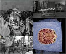 87 ਸਾਲਾ ਔਰਤ ਵੱਲੋਂ ਦਾਨ ਕੀਤੇ ਸ਼ਰੀਰ ਦੇ ਕੀਤੇ 27 ਹਜ਼ਾਰ ਟੋਟੇ