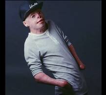 ਬੁਰੀ ਤਰ੍ਹਾਂ ਸੜਣ ਮਗਰੋਂ ਕਰਵਾਏ 87 ਆਪ੍ਰੇਸ਼ਨ, ਹੁਣ ਹੈ ਕਾਮਯਾਬ ਮਾਡਲ