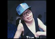 ਬੁਰੀ ਤਰ੍ਹਾਂ ਸੜਣ ਮਗਰੋਂ ਕਰਵਾਏ 87 ਆਪ੍ਰੇਸ਼ਨ, ਹੁਣ ਹੈ ਕਾਮਯਾਬ ਮਾਡਲ