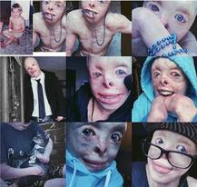 ਬੁਰੀ ਤਰ੍ਹਾਂ ਸੜਣ ਮਗਰੋਂ ਕਰਵਾਏ 87 ਆਪ੍ਰੇਸ਼ਨ, ਹੁਣ ਹੈ ਕਾਮਯਾਬ ਮਾਡਲ