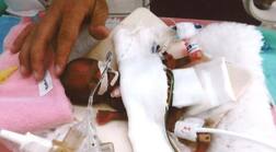 ਡਾਕਟਰਾਂ ਨੇ ਸੇਬ ਜਿੰਨੇ ਆਕਾਰ ਦੇ ਬੱਚੇ ਨੂੰ ਦਿੱਤੀ ਨਵੀਂ ਜ਼ਿੰਦਗੀ