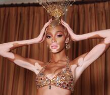 ਸਕਿਨ ਪ੍ਰੋਬਲਮ ਨੂੰ ਨਜ਼ਰਅੰਦਾਜ਼ ਕਰ ਮੇਟ ਗਾਲਾ ਇਵੈਂਟ \'ਚ ਪਹੰਚੀ ਅਸਲ ਸਟਾਰ