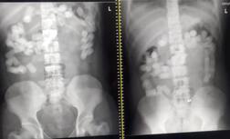 ਨਸ਼ਾ ਤਸਕਰੀ ਲਈ ਜਾਨਲੇਵਾ ਜੁਗਾੜ! ਢਿੱਡਾਂ 'ਚ ਇੰਝ ਲਕੋਈ ਹੈਰੋਇਨ