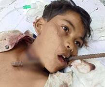 ਖੇਡਦੇ ਬੱਚੇ ਦੇ ਮੂੰਹ 'ਚੋਂ ਸਰੀਆ ਹੋਇਆ ਆਰ-ਪਾਰ