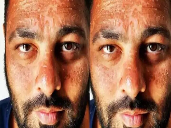 Rapper Badshah's face turned bad, shared a photo and explained why this happened ਰੈਪਰ ਬਾਦਸ਼ਾਹ ਦੇ ਚੇਹਰੇ ਦਾ ਹੋਇਆ ਬੁਰਾ ਹਾਲ, ਫੋਟੋ ਸ਼ੇਅਰ ਕਰਕੇ ਦੱਸਿਆ ਕਿਉਂ ਹੋਇਆ ਇੰਝ  