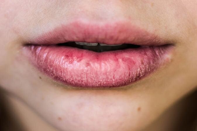 know the 5 unknown reasons behind your cracked lips, not only other cold weather ਸਰਦੀਆਂ ਸ਼ੁਰੂ ਹੁੰਦੇ ਹੀ ਫਟੇ ਬੁੱਲ੍ਹਾਂ ਦੀ ਪ੍ਰੇਸ਼ਾਨੀ, ਸਿਰਫ ਠੰਢ ਨਹੀਂ, ਇਹ ਨੇ ਇਸ ਦੇ ਪੰਜ ਕਾਰਨ