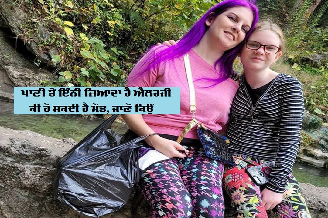 Girl, 12, is so allergic to water that having a shower could KILL her 12 ਸਾਲਾ ਲੜਕੀ ਨੂੰ ਪਾਣੀ ਤੋਂ ਐਲਰਜੀ, ਨਹਾਉਣ ਨਾਲ ਵੀ ਹੋ ਸਕਦੀ ਮੌਤ