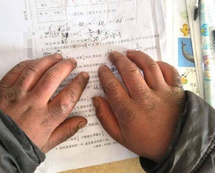 8 જાન્યુઆરીએ તે સાડા ચાર કિ.મી. ચાલીને ક્લાસમાં પહોંચ્યો ત્યારે તેના વાળ અને પાંપણો પર બરફ જામી ચૂક્યો હતો અને હાથમાં ફોલ્લા પડી ગયા હતા. 