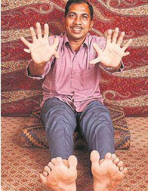  વૈશ્વિક નામના અપાવનાર 28 આંગળીઓના કારણે દેવેન્દ્રભાઇને નાનપણમાં અનેક સમસ્યાઓનો સામનો કરવો પડ્યો છે. 28 આંગળીઓવાળા ધરાવતા હોવાથી શાળામાં સાથી મિત્રો તેમને ચીડવતાં હતાં. લગ્ન માટે પણ કન્યાઓ તેમને ના પાડી દેતી હતી. તેઓ ખુદ સુથારી કામ કરે છે જેમાં થોડી તકલીફ પડે છે અને તેમના પગના માપના બૂટ તો હજી સુધી મળ્યાં નથી. 