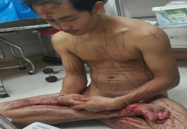 એલીટ રીડર્સના રિપોર્ટ મુજબ, ‘આ વ્યક્તિ એડલ્ટ ફિલ્મ જોતો હતો. ફિલ્મ જોતી વખતે તે એટલો ઉત્તેજિત થઈ ગયો કે તેનો પ્રાઇવેટ પાર્ટ જ કાપી નાંખ્યો. જોતજોતામાં તેના શરીરમાંથી એટલું લોહી વહી ગયું કે તે જમીન પર ઢળી પડ્યો. જે બાદ તેણે ઇમરજન્સી કોલ કર્યો.’ 