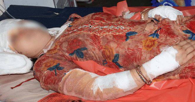 ડીબી હોસ્પિટલના સર્જન ડૉ. સંદીપ અગ્રવાલે જણાવ્યું કે મહિલાના શરીર પર લગભગ 50 જખમ હતા. તેને ભરવા માટે અમારે 275 ટાંકા લગાવવા પડ્યા. આરોપી સસરાએ ઝેર ખાઈ લેતાં તેનું મોત થઇ ગયું. સસરાના ભાઈએ રિપોર્ટ આપ્યો કે તેનો મોટોભાઈ જમ્યા પછી દીકરાના ઘરે ગયો હતો. રાતે બે વાગે તેની ભાભીનો ફોન આવ્યો કે તારા ભાઈએ કંઇક ખાઇ લીધું છે, જેનાથી તેની તબિયત ખરાબ થઈ ગઈ છે.