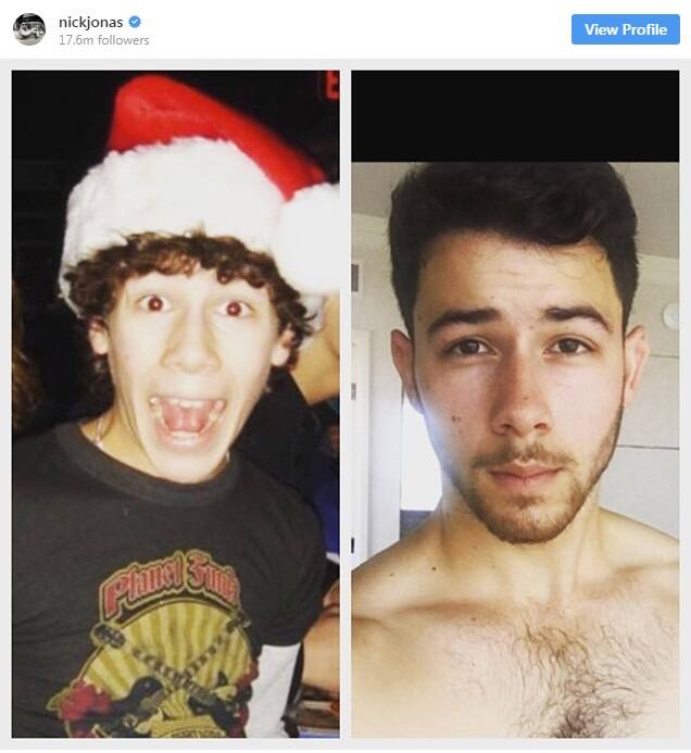 નિકે ઇન્સ્ટાગ્રામ પર બે તસવીર શેર કરતાં લખ્યું કે, 13 વર્ષ પહેલા મને ટાઈમ 1 ડાયાબિટીસની જાણ થઈ હતી. મારું વજન ખૂબ ઓછું થયું હતું. ડોક્ટર પાસે ગયા પછી મને ખબર પડી કે હું ડાયાબિટીક છું. હું મારા સ્વાસ્થ્યને ખૂબ જ મહત્વ આપું છું. વર્કઆઉટ કરીને શુગર કન્ટ્રોલમાં રાખું છે. આ બીમારી સાથે જ જિંદગી પર પણ મારો કન્ટ્રોલ છે. હું મારા પરિવાર અને ફેન્સનો આભાર માનું છું. જેમણે મને જીવનમાં મારો સાથ આપ્યો.