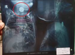 સુરતઃ એક વર્ષનું બાળક બટન સેલ ગળી જતાં અન્નનળીમાં ફસાઇ ગયો, અઢી એમએમનો હતો સેલ