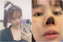 એક્ટ્રેસે કરાવી નાકની સર્જરી, અણઘડ ડોક્ટરે લોચો મારતાં થઈ ગઈ બૂચી, જુઓ કેવા થયા હાલ ?