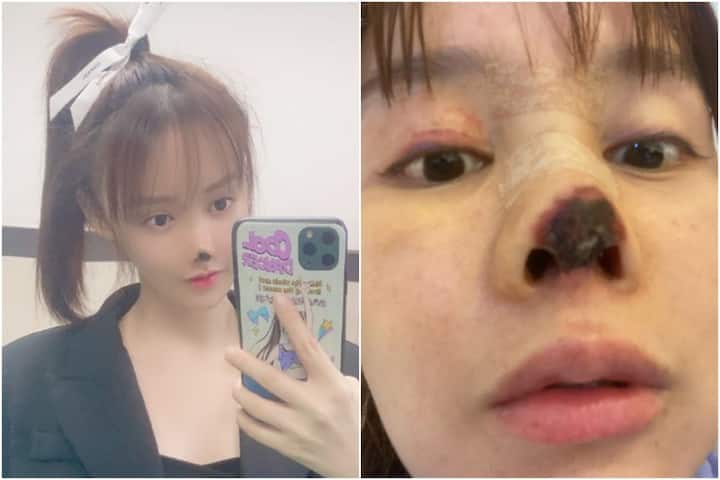 એક્ટ્રેસે સોશિયલ મીડિયા પર વ્યથા વ્યક્ત કરતા જણાવ્યું કે, સર્જરી મારા માટે આત્મઘાતી પગલા સમાન સાબિત થઇ છે. તેમણે લખ્યું હતું કે, સર્જરીના કારણે મારી કરિયર પણ હવે ખતમ થઇ ગઇ છે. મને હવે ક્યારેય કોઇ ઓફર નહીં મળે”