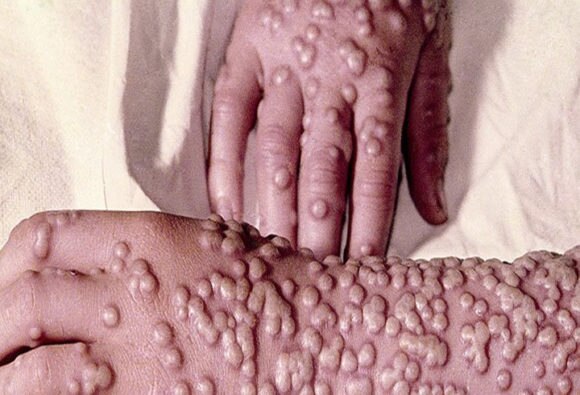 smallpox